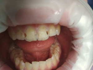 1-й пациент до лечения кариеса зубов