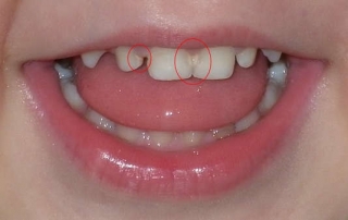 кариес зубов у детей