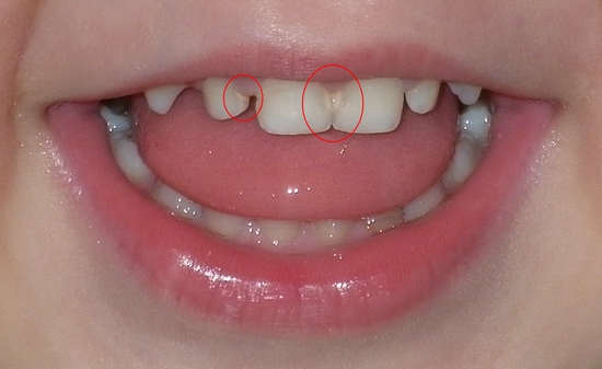 кариес зубов у детей