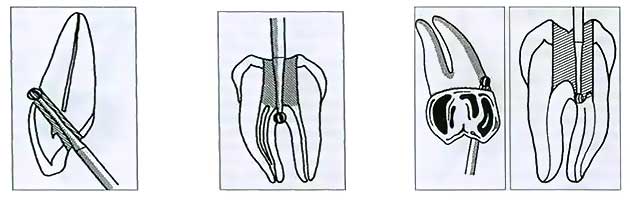 Восстановление Перфорации корня зуба 