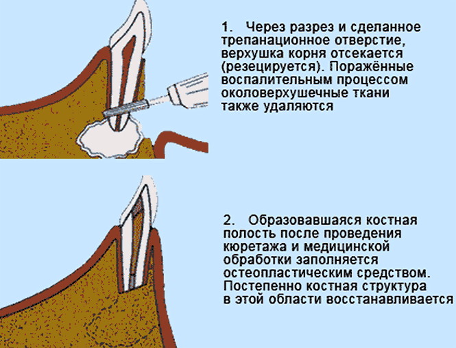 Резекция  зуба